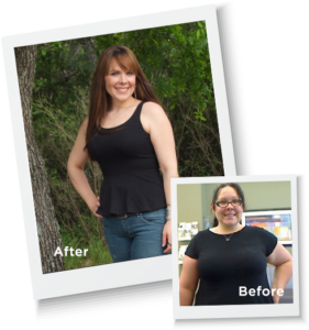 After Weigh Loss Surgery